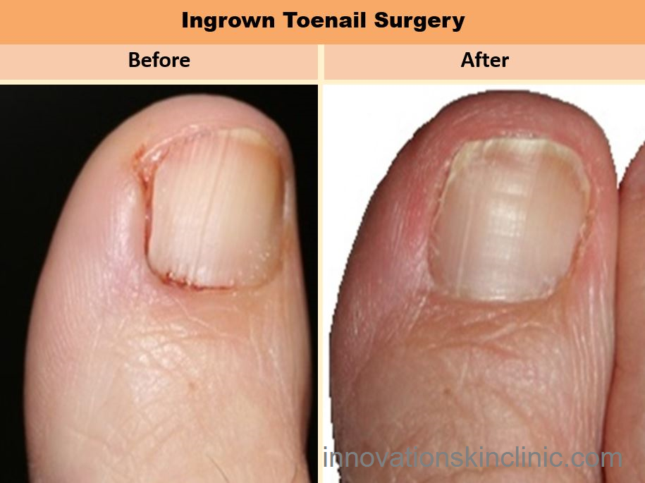 Nail Ingrown Toenail Removal